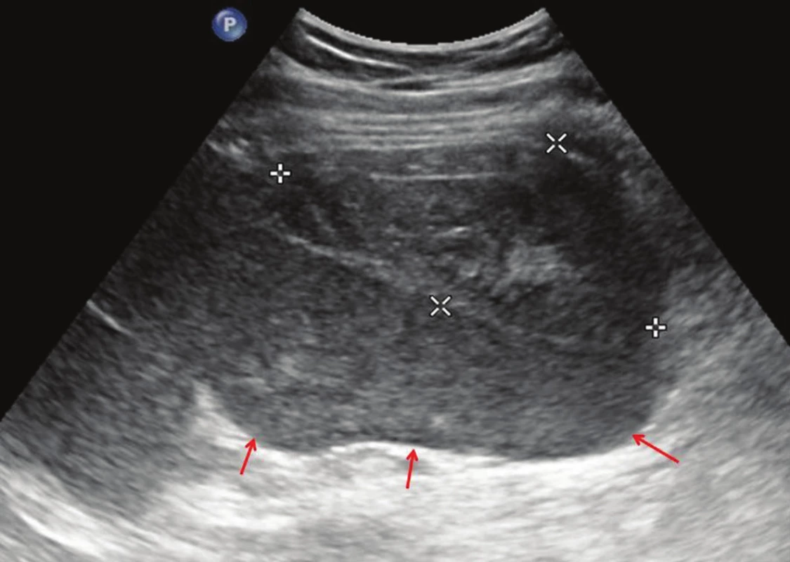 Ultrazvukové vyšetření břicha - podélný řez slezinou v koronární rovině (červené šipky). Slezina nehomogenní, tvarově defigurovaná. Při jejím laterálním okraji hypoechogenní nehomogenní formace vzhledu koagulovaného hematomu (bílé křížky).