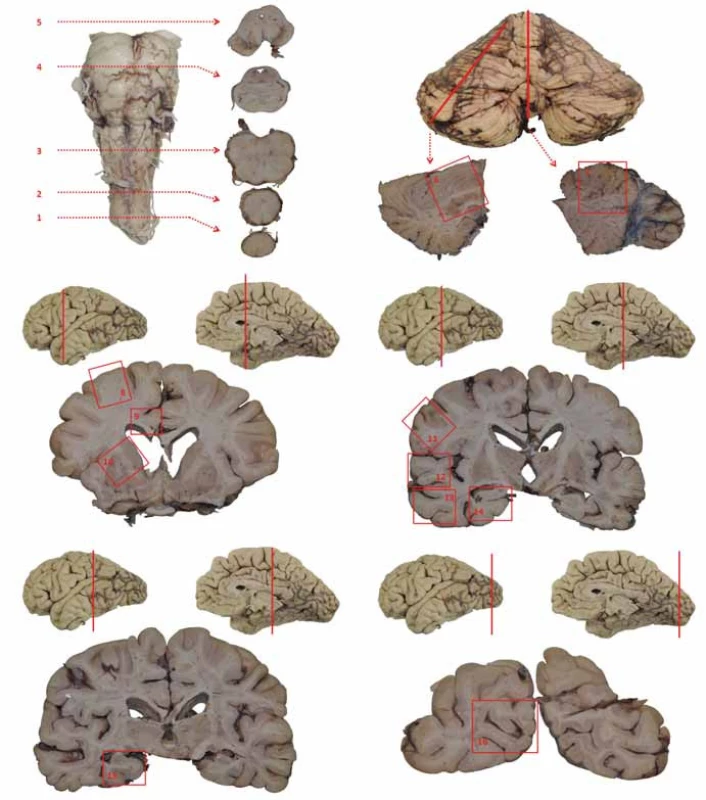 Schéma základního odběru při pitvě mozku.
1 – segment C1; 2 – bulbus; 3 – prodloužená mícha; 4 – pons na úrovni locus coeruleus; 5 – mezencefalon na úrovni odstupu n. III. se substantia nigra; 6 – hemisféra mozečku; 7 – vermis; 8 – frontální kortex (střední frontální závit); 9 – gyrus cinguli; 10 – bazální ganglia – striatum; 11 – somatomotorický kortex; 12 – horní temporální závit (T1); 13 – střední a dolní temporální závit (T2, 3); 14 – přední hipokampus; 15 – zadní hipokampus; 16 – primární zraková kůra
Fig. 1. Basic brain areas sampled during autopsy. 1 – C1 segment; 2 – bulbus; 3 – medulla oblongata; 4 – pons at the level of the locus coeruleus; 5 – midbrain at the level of the oculomotor nerve with substantia nigra; 6 – cerebellar hemisphere; 7 – vermis cerebelli; 8 – frontal cortex (middle frontal gyrus); 9 – cingular gyrus; 10 – basal ganglia – striatum; 11 – somatomotor cortex; 12 – superior temporal gyrus (T1); 13 – middle and inferior temporal gyrus (T2, 3); 14 – anterior hippocampus; 15 – posterior hippocampus; 16 – primary visual cortex