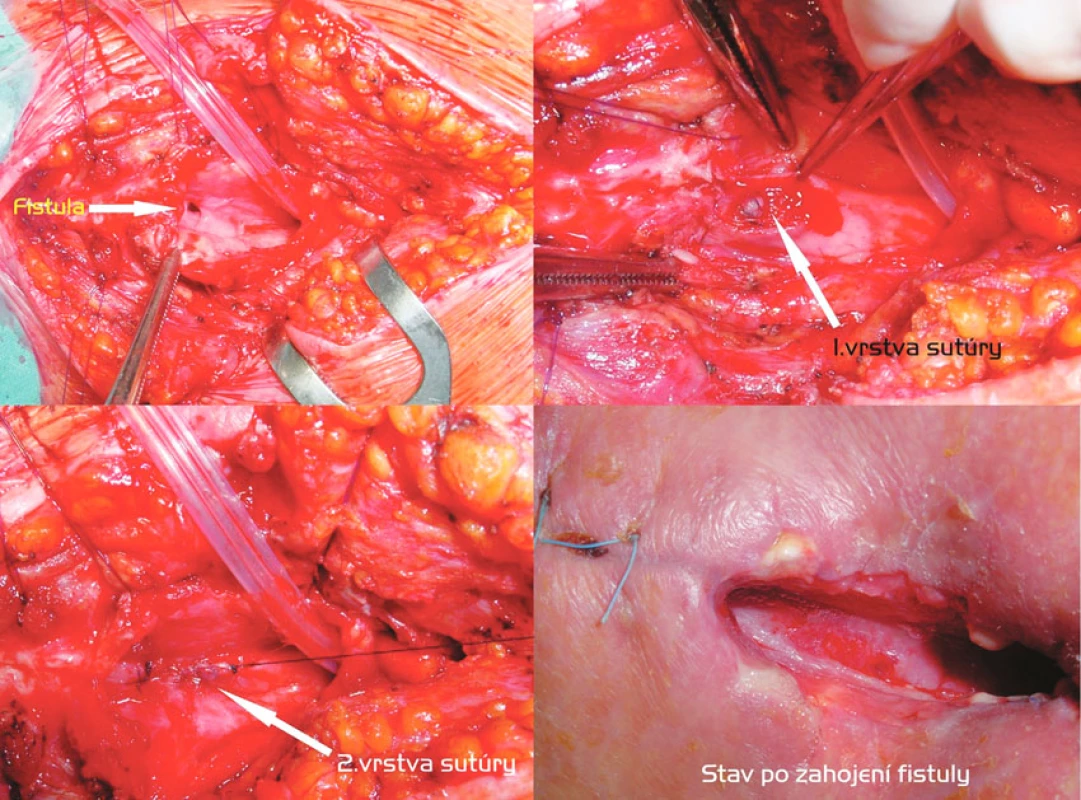 Transtracheostomická discízia fistuly, dvojvrstvová sutúra pažeráka, T-kanyla. Postup zľava doprava, zhora nadol: Discízia prednej steny trachey, ventilácia HFJV, vizualizácia fistuly. Prvá vrstva ezofageálnej sutúry. Druhá vrstva ezofageálnej sutúry. Stav po zahojení fistuly
Fig. 5. Trans-tracheostomic discision of the fistula, the double-layer esophageal suture, the T-cannula. Left to right and top to down: Discision of the anterior esophageal wall, HFJV (high frequency jet ventilation), visualization of the fistule. The first layer of the esophageal suture. The second layer of the esophageal suture. The healed fistula
