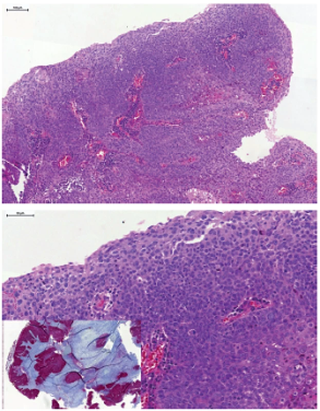 Nekeratinizujúci HPV-asociovaný orofaryngeálny karcinóm, tvorený ovoidnými bunkami s vysokým nukleocytoplazmatickým pomerom, syncyciálnym spôsobom rastu, bez intercelulárnych mostíkov. Imunohistochemicky typická difúzna silná pozitivita expresie proteínu p16 (vložený obrázok).