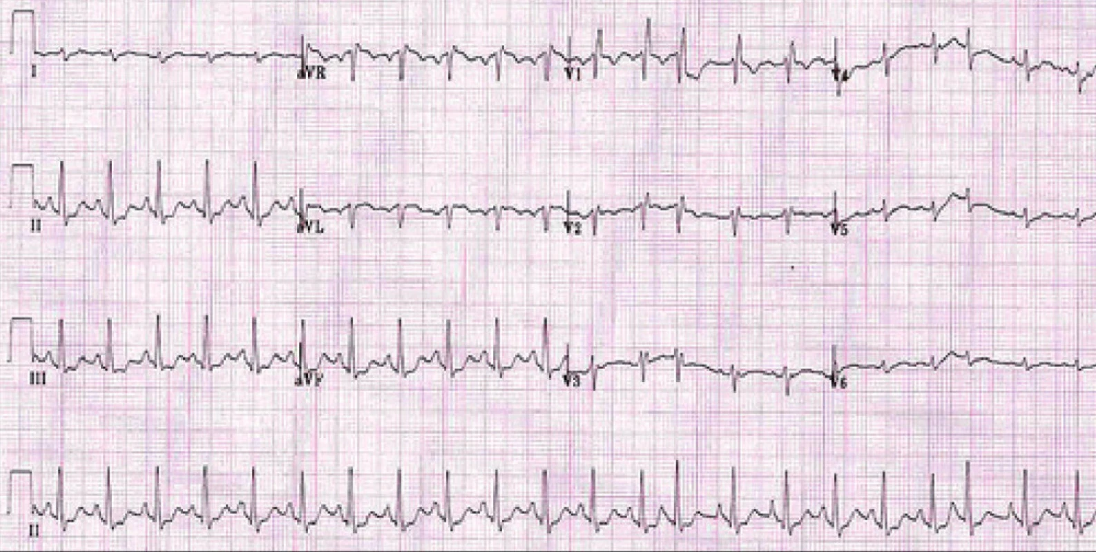 EKG u nemocného s CHOPN:
P pulmonale, blok pravého Tawarova raménka, hypertrofie pravé komory a ojedinělá supraventrikulární extrasystola.