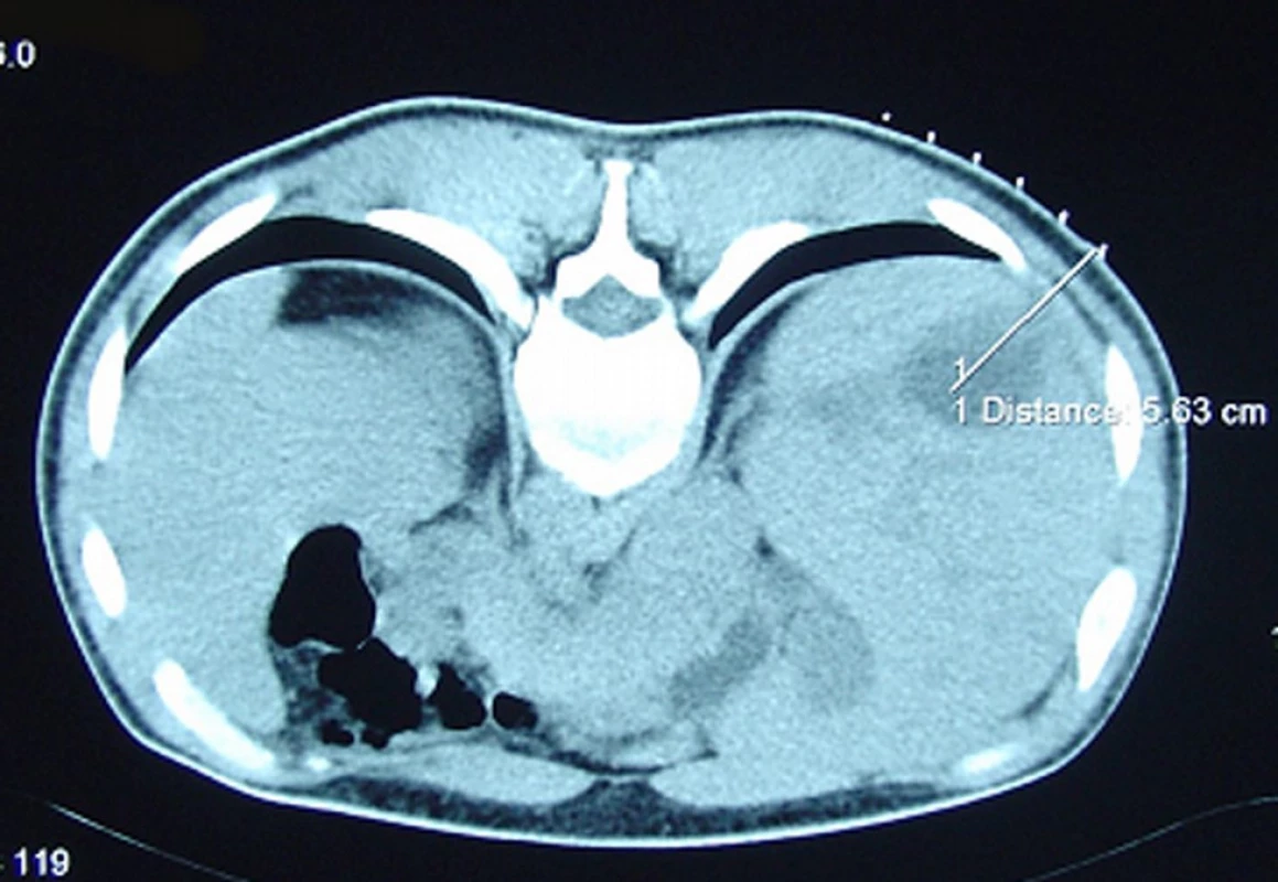 Punkce intraparenchymového hematomu po traumatické ruptuře VII. jaterního segmentu pod CT kontrolou