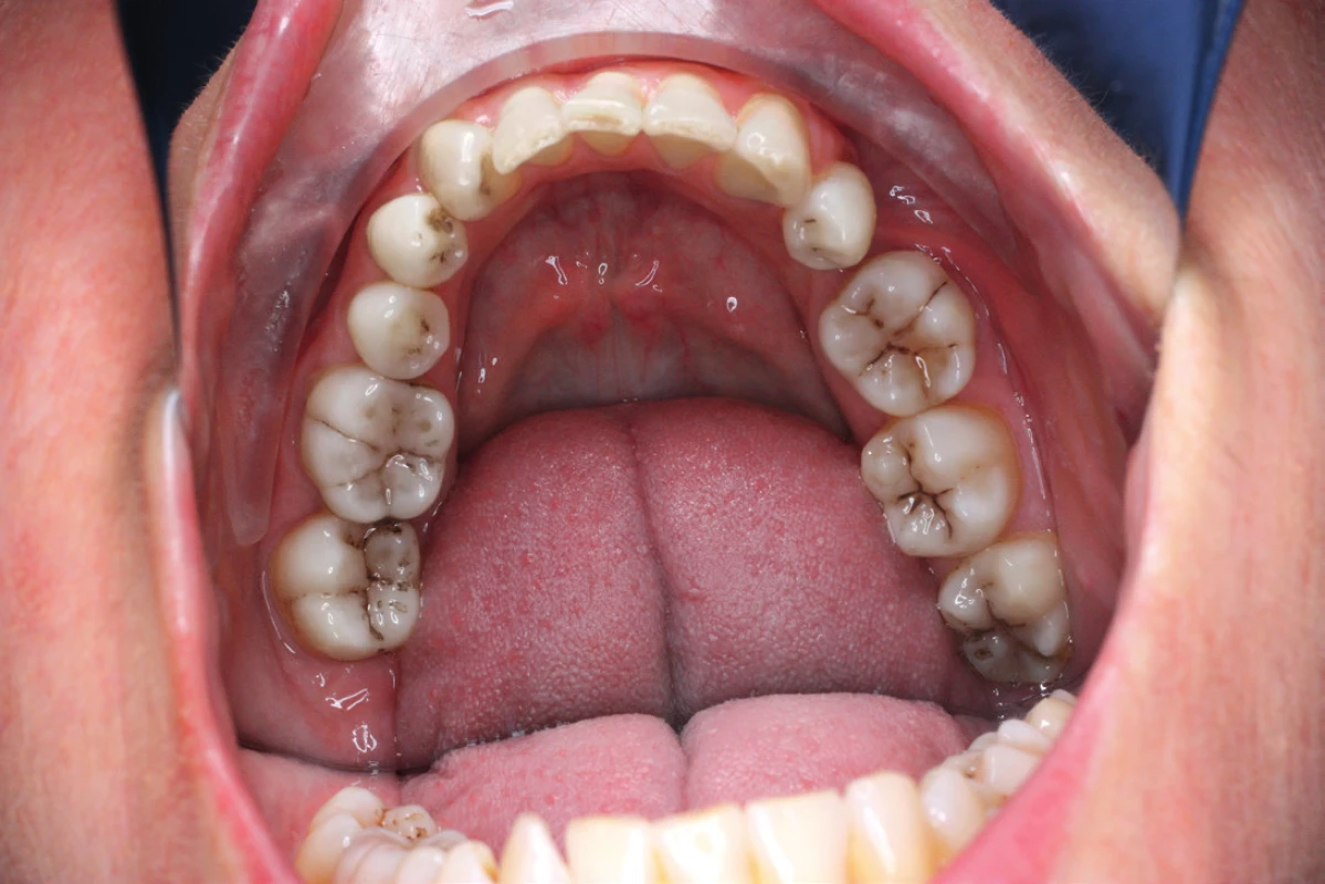 Klinické vyšetření bez vizuální detekce zubního kazu