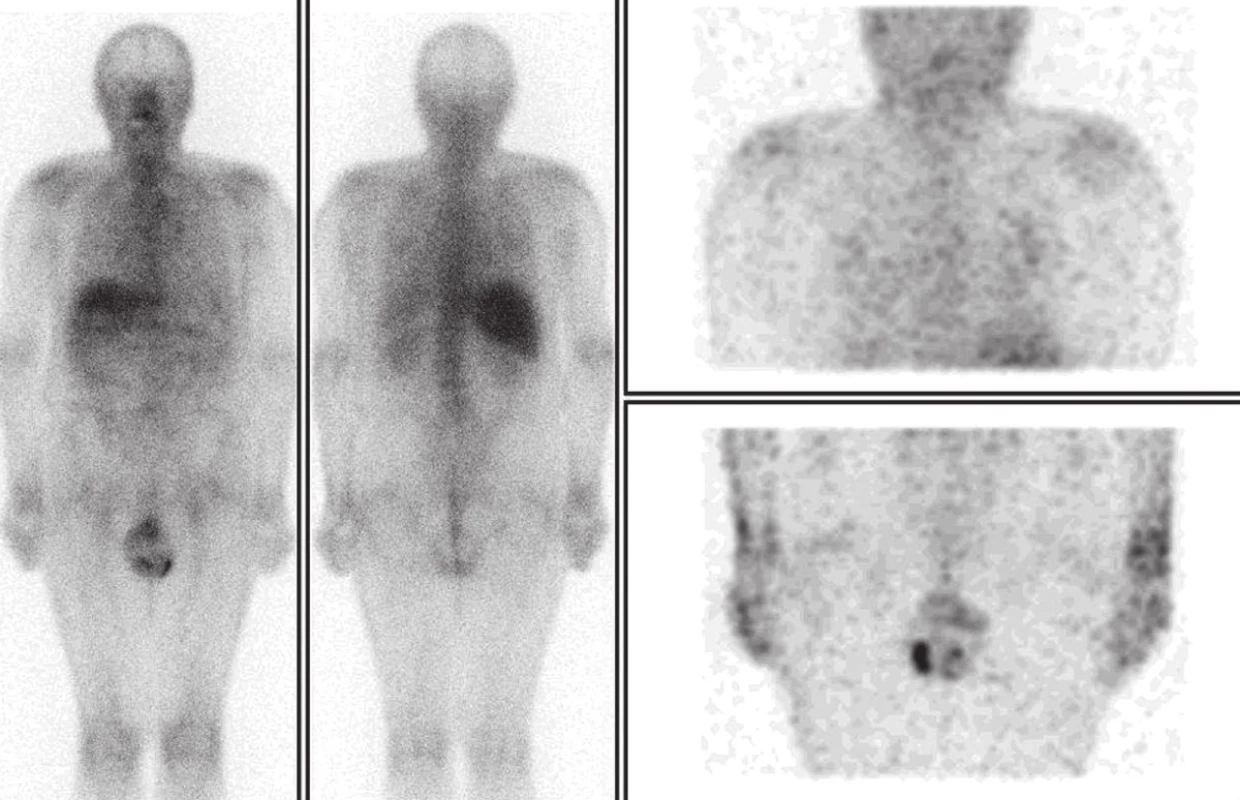 Galliová scintigrafie v srpnu 2010. Celotělový scan a SPECT hrudníku a břicha po 48 hodinách. Je patrná fyziologická distribuce v játrech, kostní dřeni a skrotu.