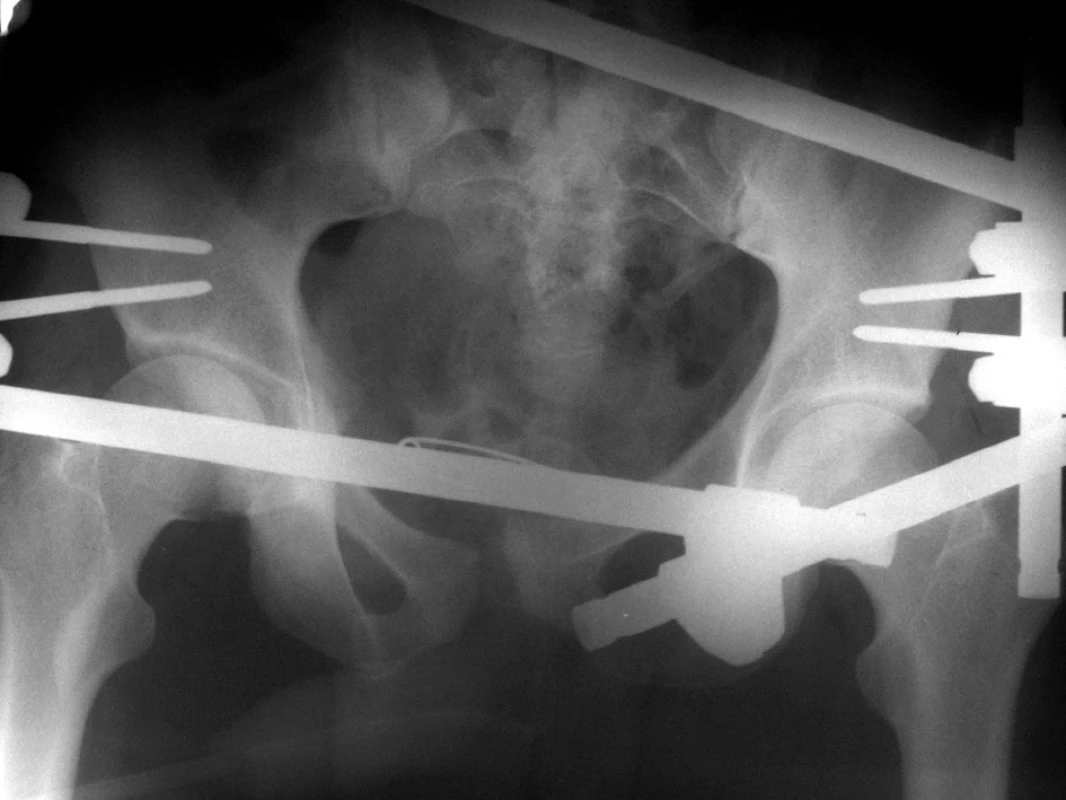 Supraacetabulárně naložená zevní fixace jako definitivní ošetření poranění pánve
Fig. 1: External fixation with supraacetabular screws as a definite treatment of pelvic injury