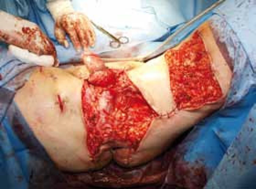 Průběh operace 
A – obříznuta kůže penisu, vnitřní list předkožky ponechán, excidována kůže nad penisem, uvolněna varlata; B – odstraněna kůže skrota (preparát byl hmotnosti 4,5 kg), rozsáhlá část kůže vnitřní plochy levého stehna a na 3 místech excidována zánětlivá ložiska na pravém stehně; C – varlata uložena oboustranně pod kůži stehen, defekty částečně staženy po stranách od anu a na levém stehně
Fig. 3.
Within the surgery
A – the skin of the penis was circumcised, the inner preputial sheet was left, the skin of the penis was removed, testicles were deliberated; B –the scrotal skin (a specimen of 4.5 kg), a large part of the internal surface of the skin of the left thigh and three inflammatory areas on the right thigh were removed; C – both testicles were placed under the skin on both sides of the thighs, defects were partially fixed along the sides from the anus and the left thigh