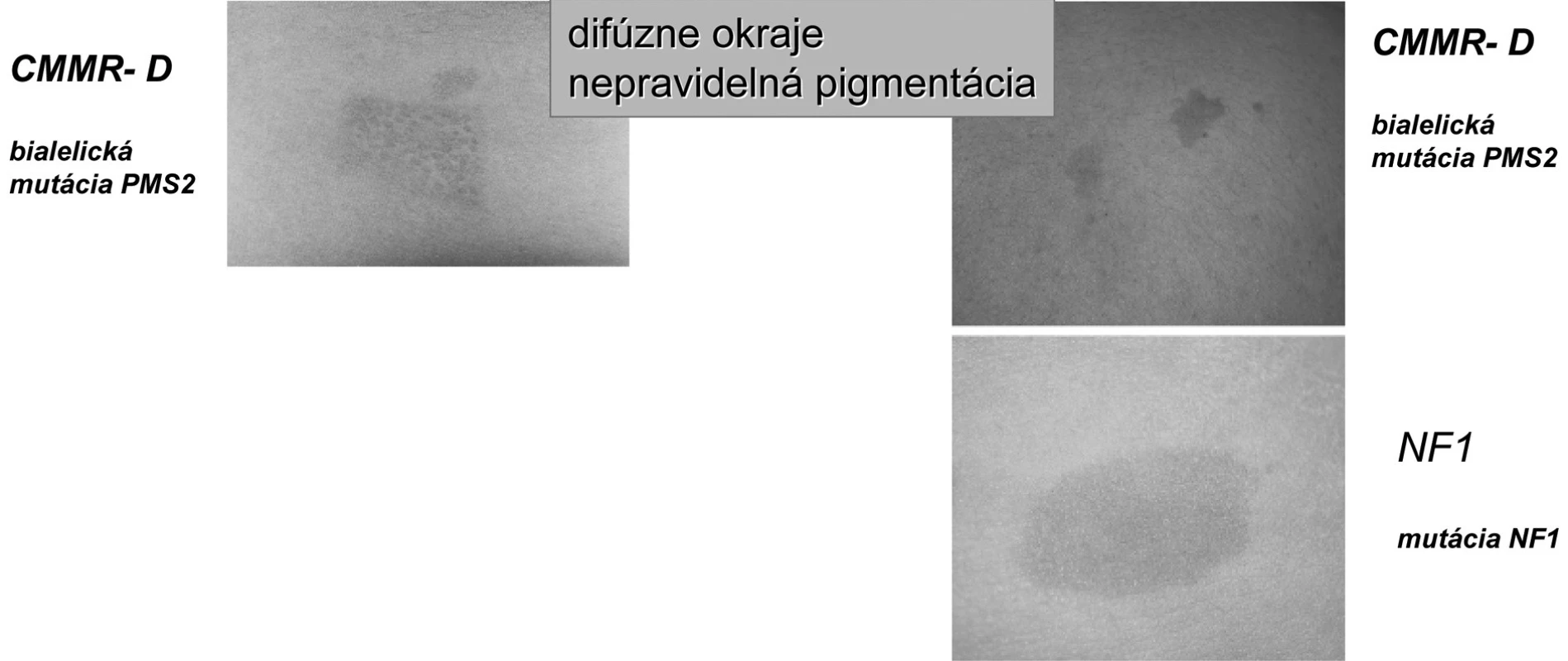 Charakter CAL pigmentácií pri syndróme deficitu konštitučného „Mismeč reparačného systému“
(CMMR-D) [18].