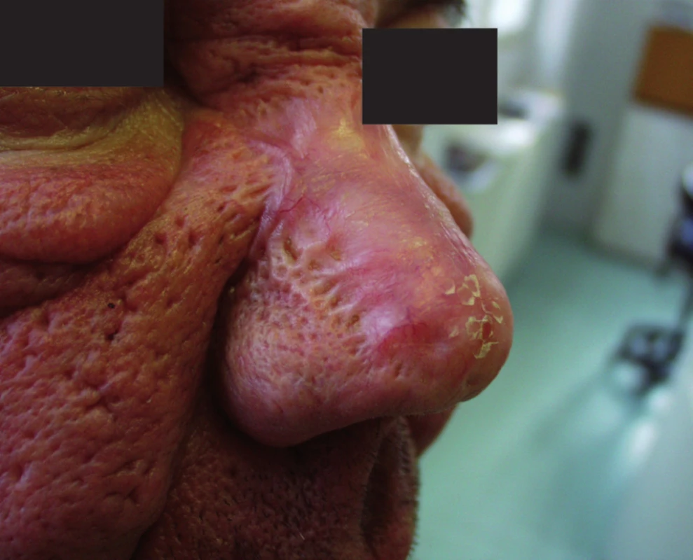 Rhinophyma – stav před operací (a) a po zhojení (b)