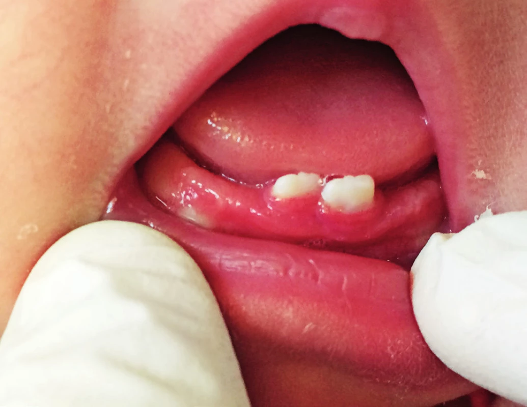 Dva natální zuby v dolní čelisti u novorozence ve věku dva týdny