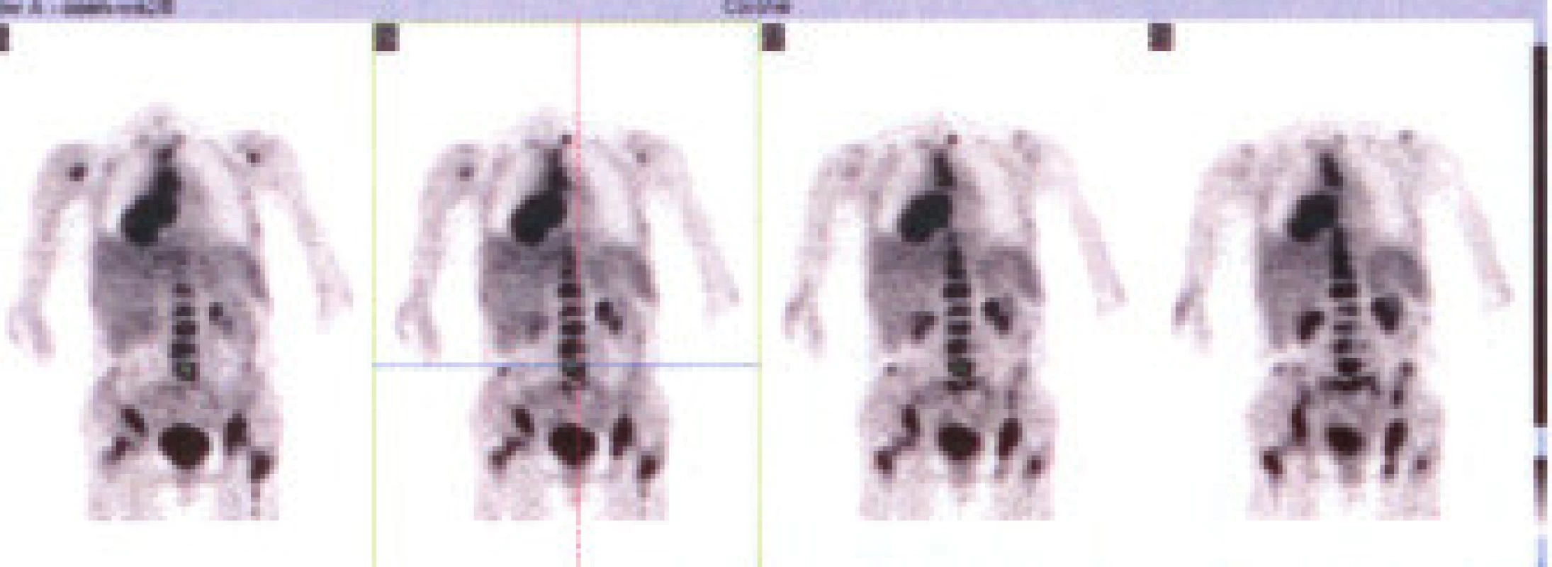 Celotělový PET s nálezem generalizovaného tumoru plic a mediastina s metastázami do skeletu.