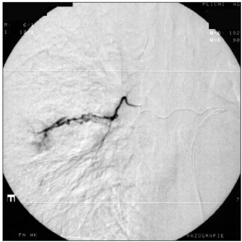 Stejná pacientka jako na obr. 2. Při následné superselektivní mikrokatétrové angiografii nalezen vpravo i arterio-arteriální zkrat.