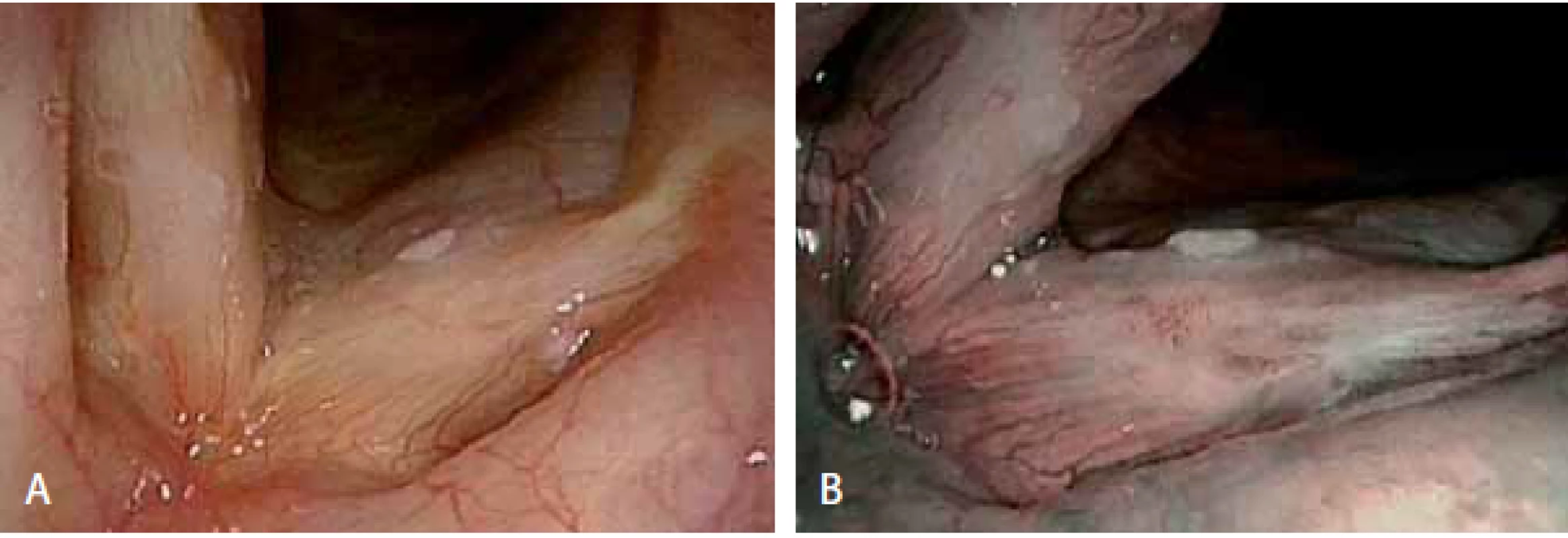 Porovnání zobrazení léze levé hlasivky při flexibilní endoskopii bílým světlem (A) a při NBI endoskopii (B) – vaskularizace typ IV–Va, histologicky verifikovaný ca &lt;i&gt;in situ&lt;/i&gt;.
