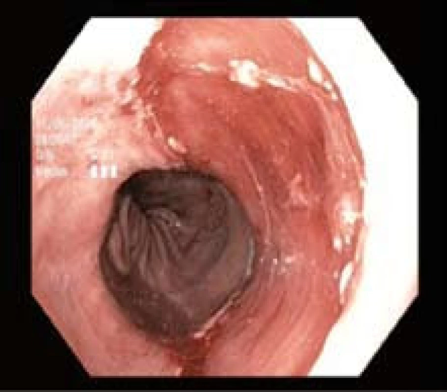 Spodina po endoskopické resekci.
Fig. 4. Resected area after endoscopic resection
