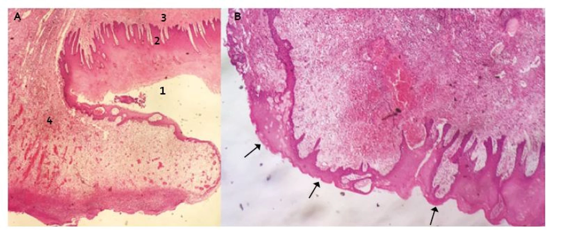 Transverzální řez distálního jícnu v místě resekční plochy s protekcí Xe-Dermou&lt;sup&gt;®&lt;/sup&gt; (Hematoxilin-Eosin): A. 1. vrstevnatý dlaždicový epitel nerohovějící – povrchová vrstva s jádry, 2. epitel vrstevnatý dlaždicový nerohovějící – vrstva bazální, 3. tunica submucosa, 4. fibrinózně hnisavý exsudát s granulační tkání (součást hojení). B. Šipky ukazují re-epitelizaci přes submukózu.
Fig. 2. Transversal incision of distal oesophagus at the resection site with Xe-Derma cover&lt;sup&gt;®&lt;/sup&gt; (Haematoxylin-Eosin): A. 1. non-keratinized stratifi ed squamous epithelium – the superficial layer, 2. non-keratinized stratified squamous epithelium – the basal layer, 3. tunica submucosa, 4. fi brinous-purulent exudate with granulation tissue (as a healing component). B. The arrows show the re-epithelialization over submucosa.
