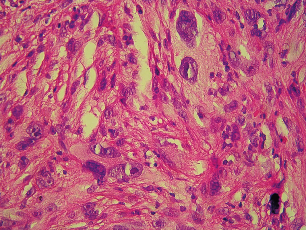 Histologický nález – nádorové buňky s výrazně pleomorfními jádry, prominujícími jadérky, největší z nich s naznačeně pěnitou cytoplazmou