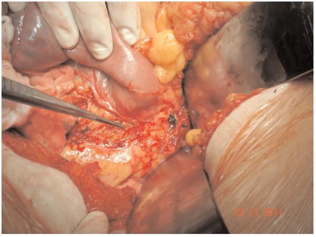 Intimní naléhání duodena na aortu (peroperační nález)
Fig. 3: Adherence of duodenum to the aorta (peroperative fading)