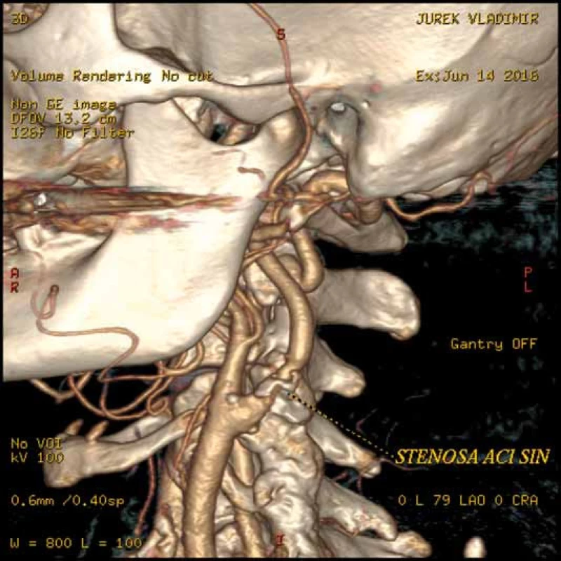 CT angiografie karotické tepny. Počítačové zpracování CT obrazu nazývané volume rendering, které zobrazuje stenózu levé vnitřní krkavice a její vztah k ostatním cévním a kostním strukturám.