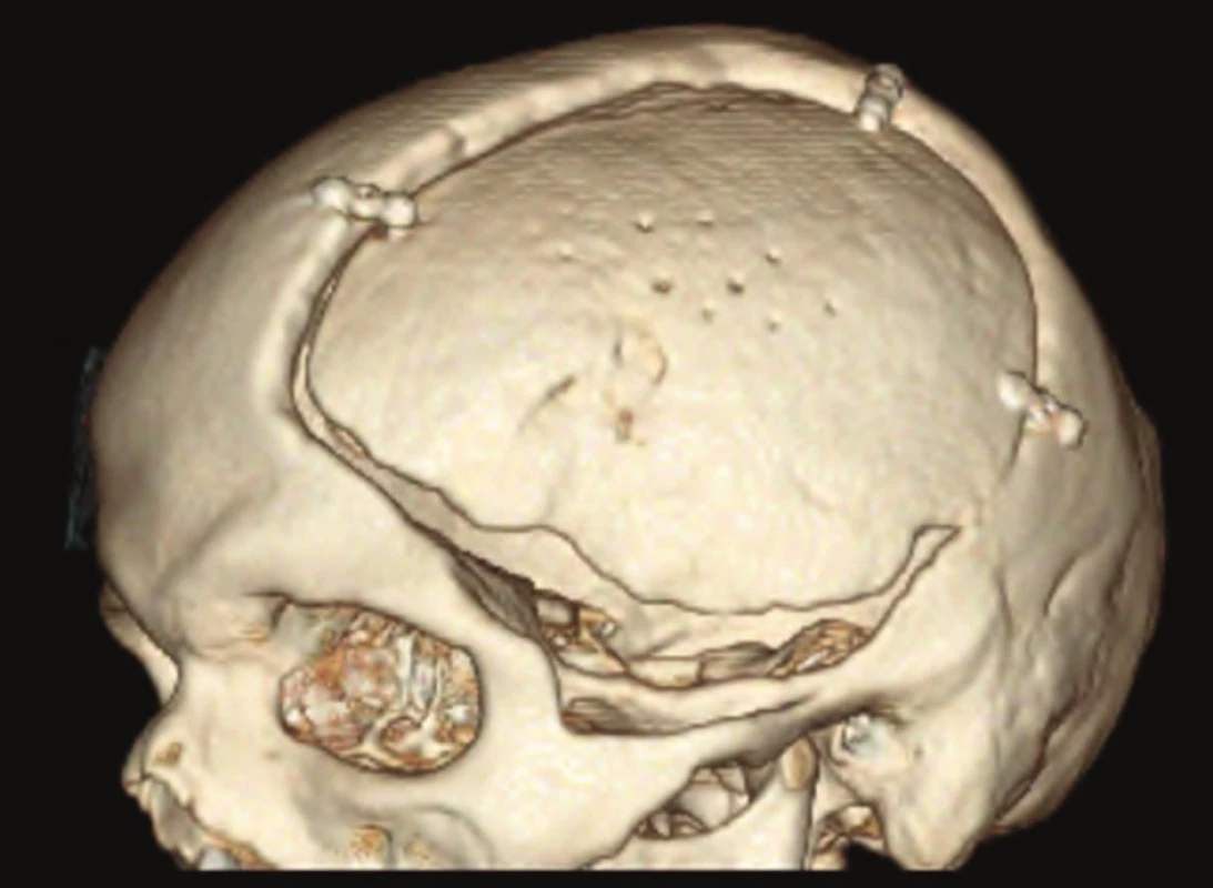 3D model lbi − kranioplastika vlastní kostí
Fig. 1: 3D reconstruction of skull − autologous cranioplasty with bone flap