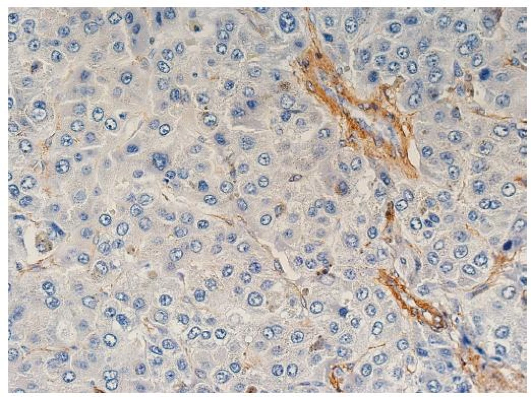 Nepárové artérie mezi trámci nádorových hepatocytů, imunohistochemický průkaz hladkosvalového aktinu, zvětšení objektiv 20x.