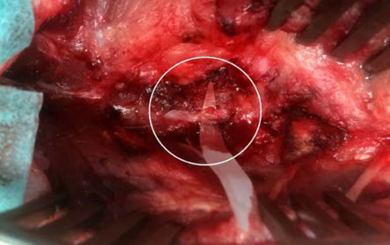 Peroperační foto – reoperace, anastomóza míšního kořene
Fig. 7. Intraoperative photo – reoperation, spinal root anastomosis