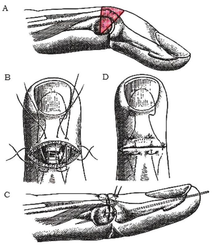 Korekcia chronickej mallet deformity
a) excízia kože a šľachového kalusa,
b) naložené matracové stehy en bloc cez kožu, šľachu a ev. kĺbové puzdro,
c) transfixovaný DIP kĺb Kirschnerovým drôtom v miernej hyperextenzii,
d) zauzlenie stehov [2].
Fig. 7: Correction of chronic mallet deformity
a) excision of skin and tendon callus,
b) placing the matrace sutures en bloc through the skin, tendon and ev. articular capsule,
c) K-wire fixes the DIP joint in slight hyperextension,
d) sutures are tied [2].