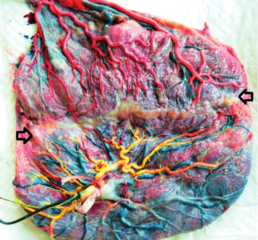 Placenta monochoriálních dvojčat po laserové ablaci cévních spojek (šipky) a provedeném barevném nástřiku arteriálních řečišť (foto archiv ÚPMD)