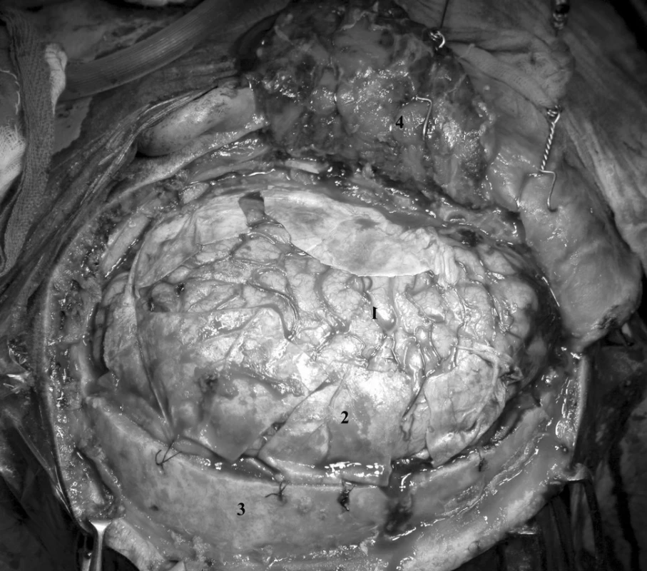 Stav po dekompresivní kraniektomii s radiálními nástřihy tvrdé pleny 1. mozek, 2. dura mater, 3. kost, 4. temporální sval