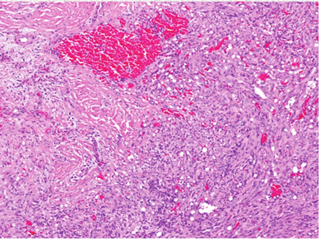 Histologický obraz vřetenobuněčného hemangiomu: typické vřetenité buňky kolem kapilár