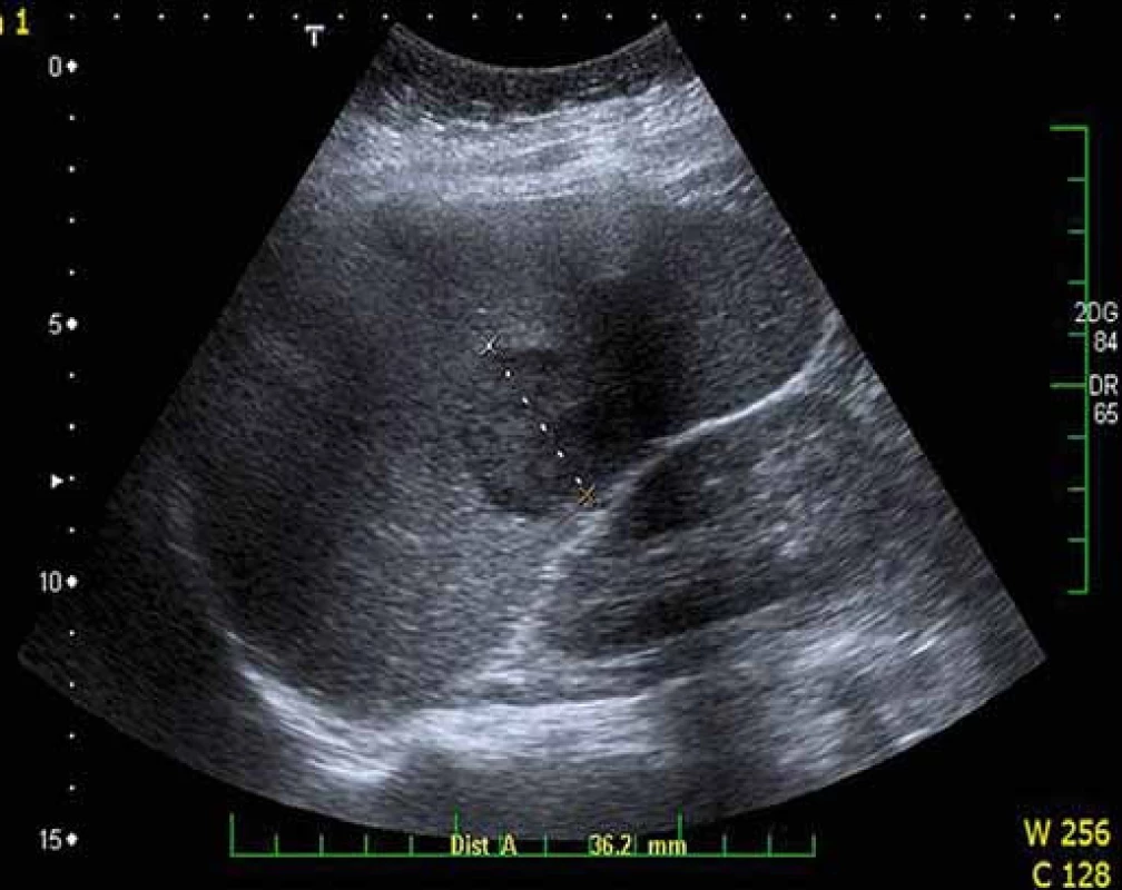 Ložisko lymfomu ve slezině. Ultrazvukové vyšetření sleziny prokazující hypoechogenní ložisko v hilu velikosti 31 mm.
Fig. 6. Lymphoma mass in the spleen. Spleen ultrasound showing hypoechogenic mass in the spleen, 31 mm in diameter.