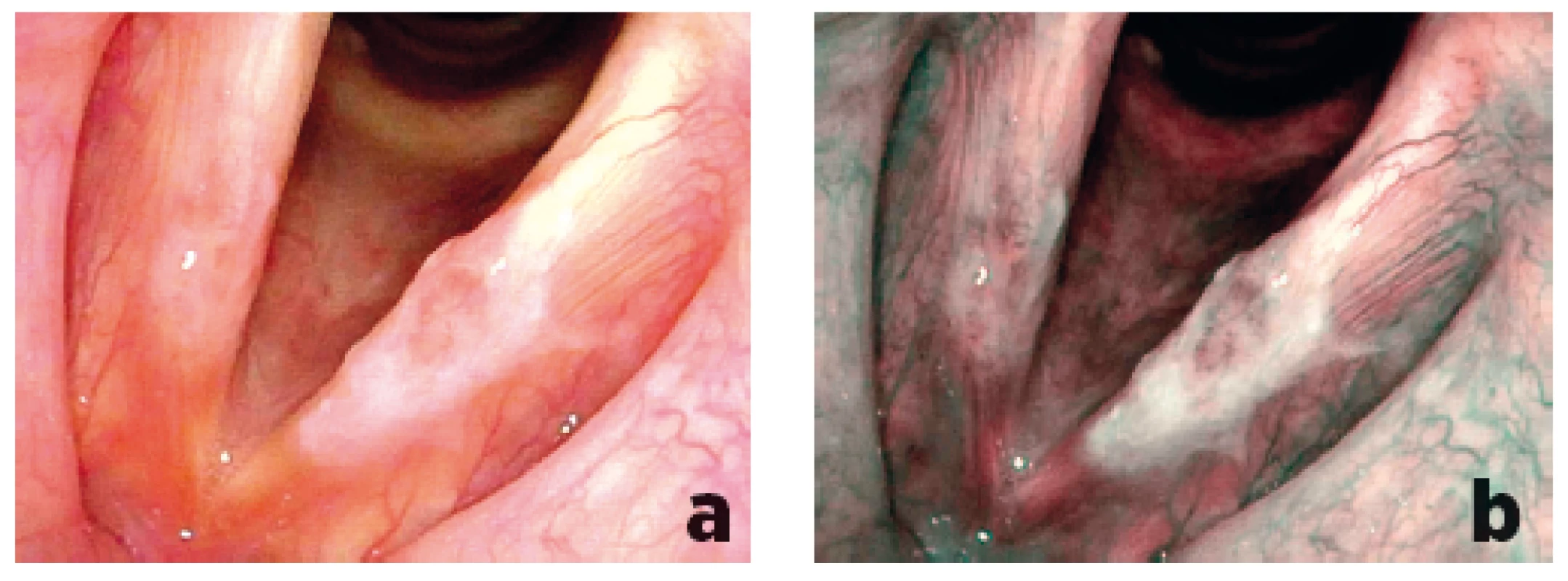 Porovnání zobrazení plošné leukoplakické léze levé hlasivky při flexibilní endoskopii bílým světlem (a) a při NBI endoskopii (b) – v NBI endoskopii viditelný větší plošný rozsah léze, patologická vaskularizace Typ Va zjištěna nejen na levé, ale také na pravé hlasivce, histologicky prokázán carcinoma in situ na obou hlasivkách.