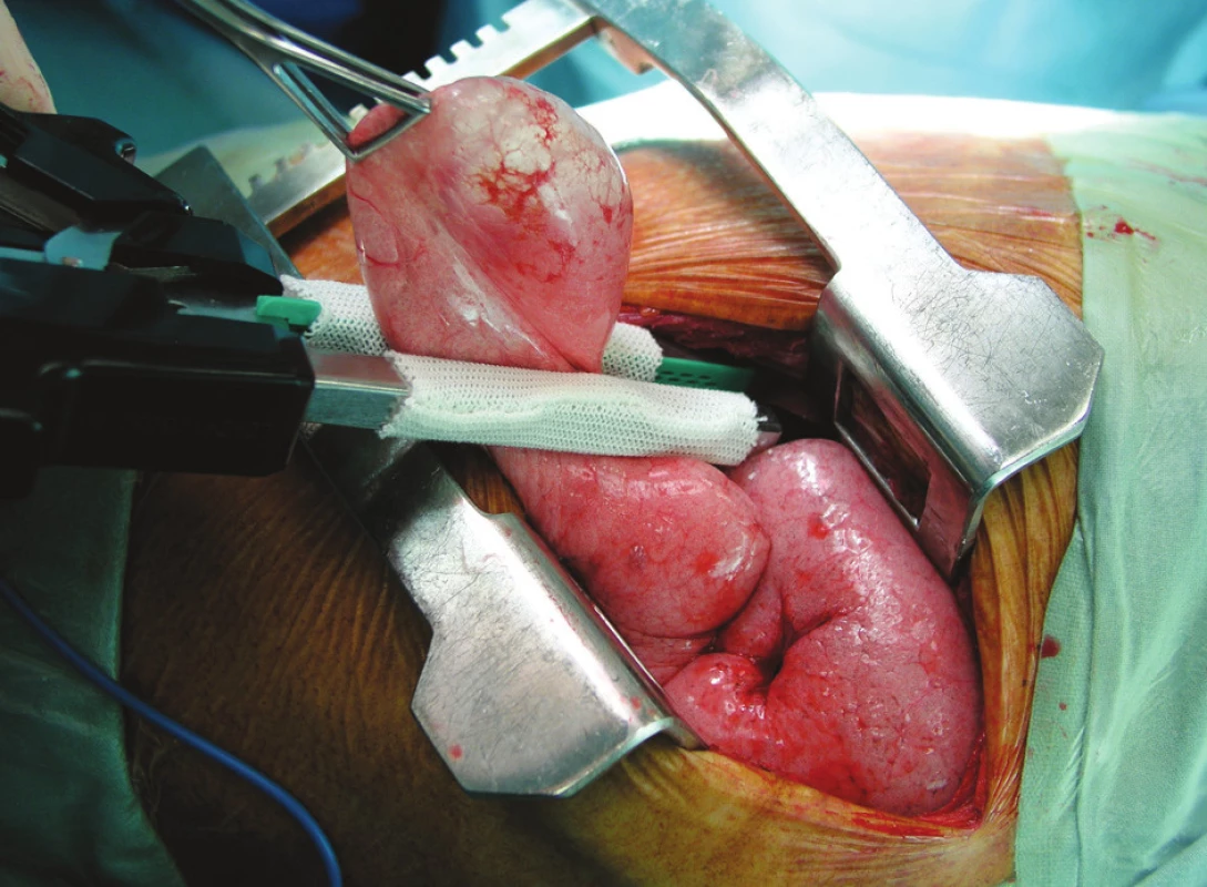Resekce plicní buly pomocí stapleru s návlekem
Fig. 2. Resection of pulmonary bullae by stapler with slip‘s