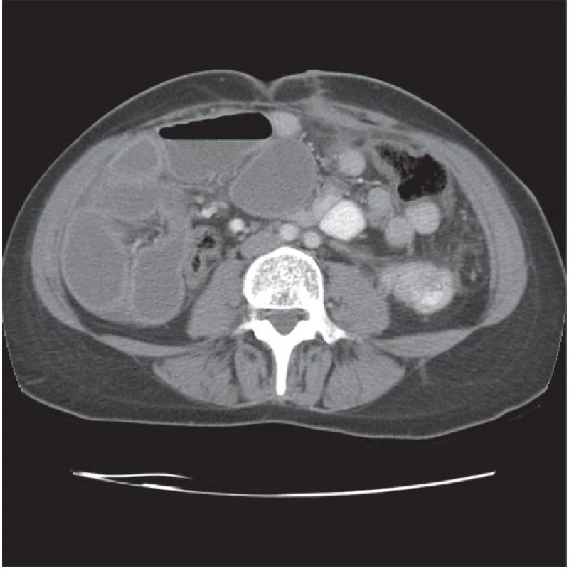 CT: Distendované střevní struktury, ileózní stav
Fig. 3 CT: Distended bowel, status ileosus