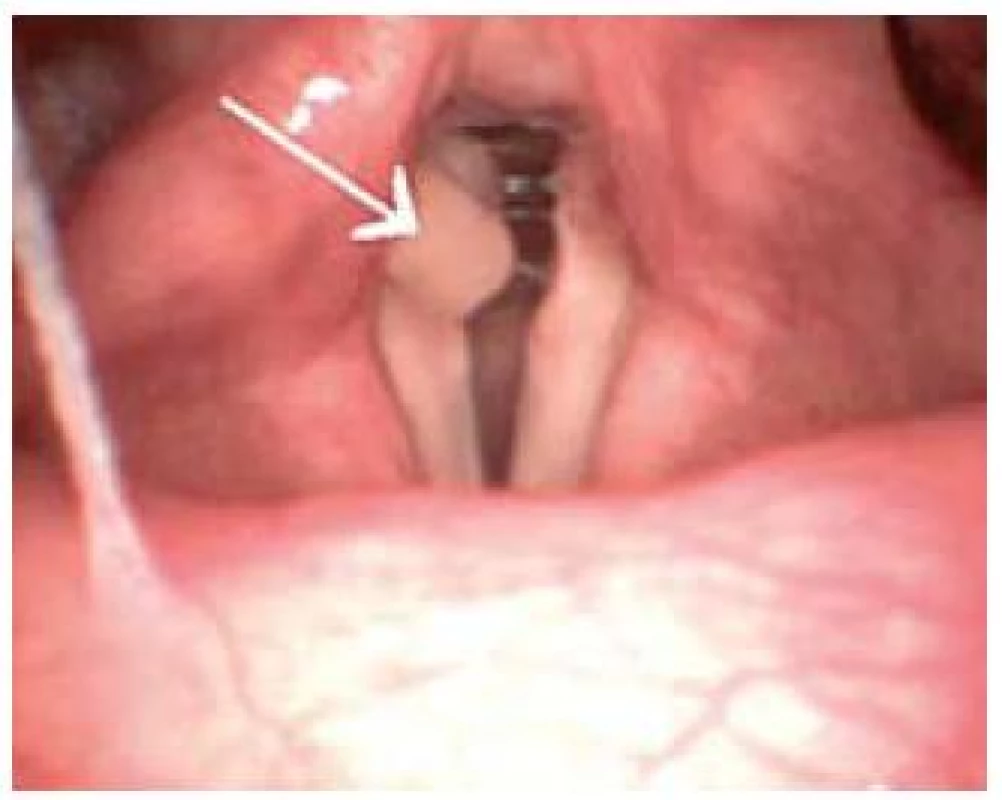 Granulom pravé hlasivky (označený šipkou) způsobený extraezofageálním refluxem.
Fig. 1. Granuloma of the right vocal chord (arrow) caused by extraesophageal reflux.