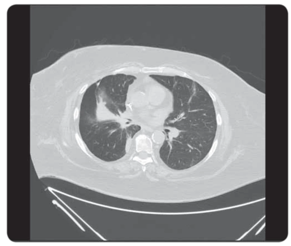 Kazuistika 2, CT hrudníku 6/2019 (před zahájením léčby).
©FNOL 2019.<br>
CT – výpočetní tomografie
