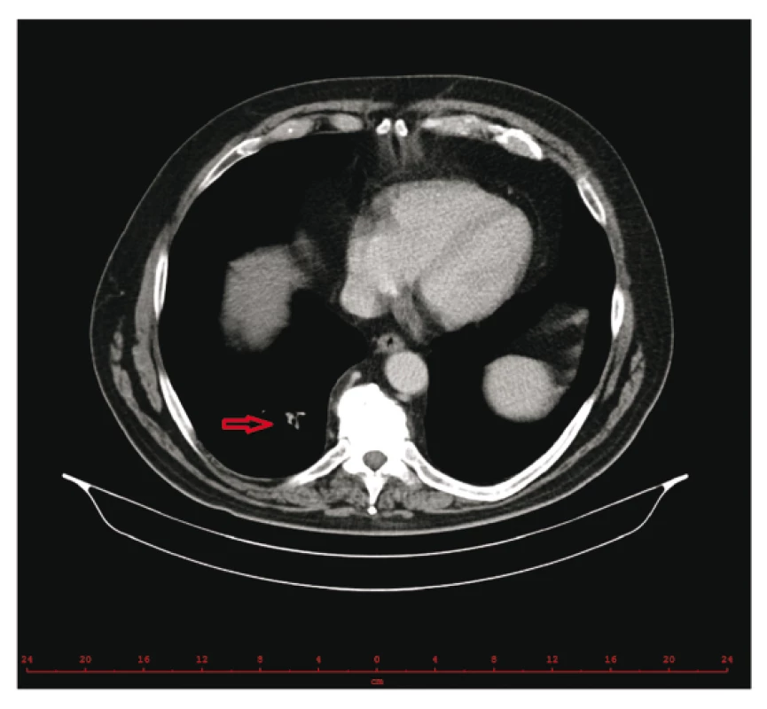 Reziduum plicní
metastázy po 30 měsících
léčby nivolumabem –
dlouhodobě stacionární
(zdroj: Radiodiagnostická
klinika VFN)