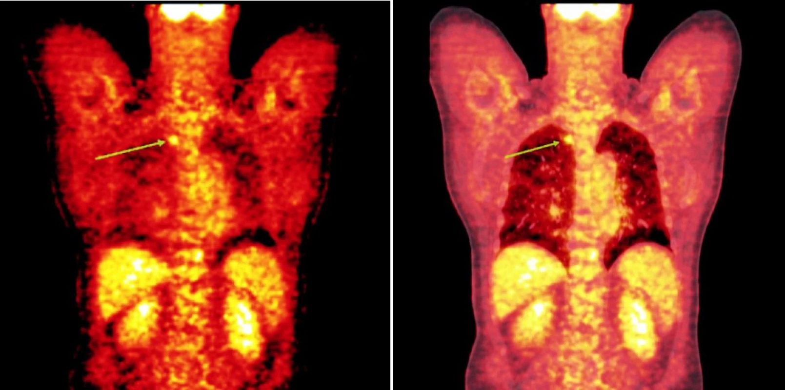 Srovnání snímků pozitronové emisní tomografie (s použitím 18F-fluoro-deoxy-glukózy) (a) a integrované pozitronové emisní tomografie s počítačovou tomografií (b) po skončení léčby 90Y-ibritumomab tiuxetanem u třetího pacienta s folikulárním lymfomem a nálezem ložiska v plicním parenchymu.