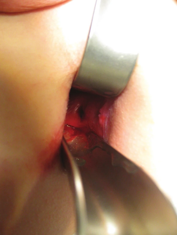 Bodná rána rekta vel. 1 cm s lacerovanými okraji
Fig. 5: Stab wound of the rectum, size 1cm with lacerated edges