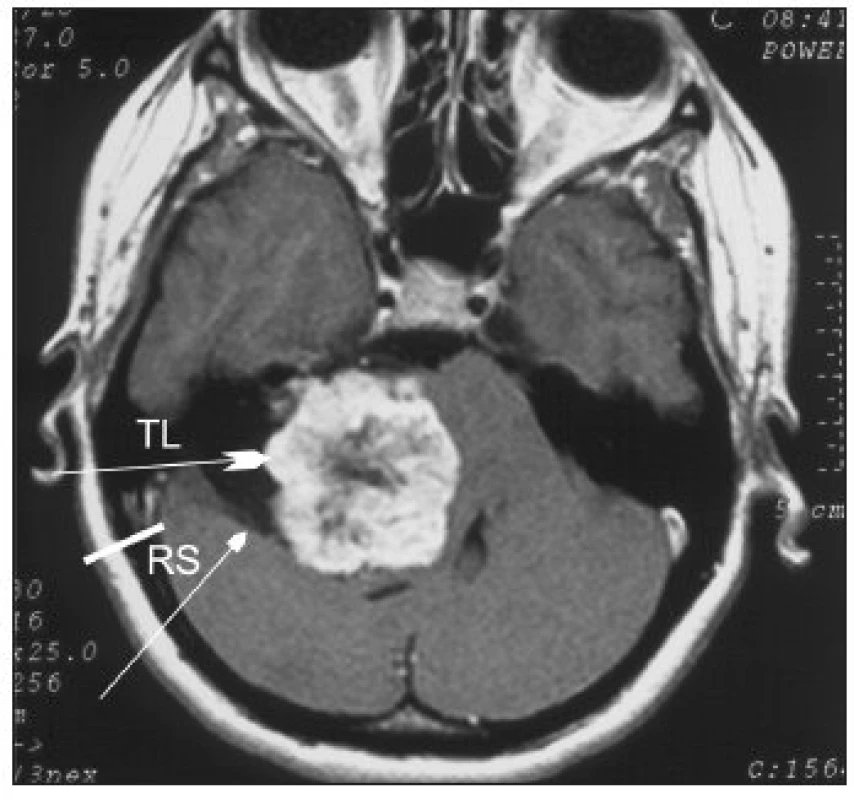 Vestibulárny schwannom vpravo veľkost 4,6 cm, ktorý spôsobuje veľký tlak na mozgový kmeň a mozoček, blokuje foramina Luschae, deformuje 4. komoru. Šípky ukazujú dva možné prístupy k nemu
Legenda: TL - translabyrintný, RS - retrosigmoidný. Dvadsaťštyriročná pacientka mala pri takomto tumore sluch úplne v norme.