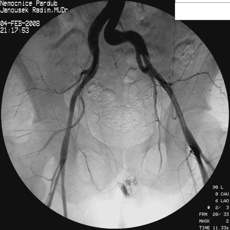 Arteriogram s průkazem krvácení v povodí oboustranných aa. iliacae internae
Fig. 2. Angiography view of the bleeding from branches of internal iliacal arteries