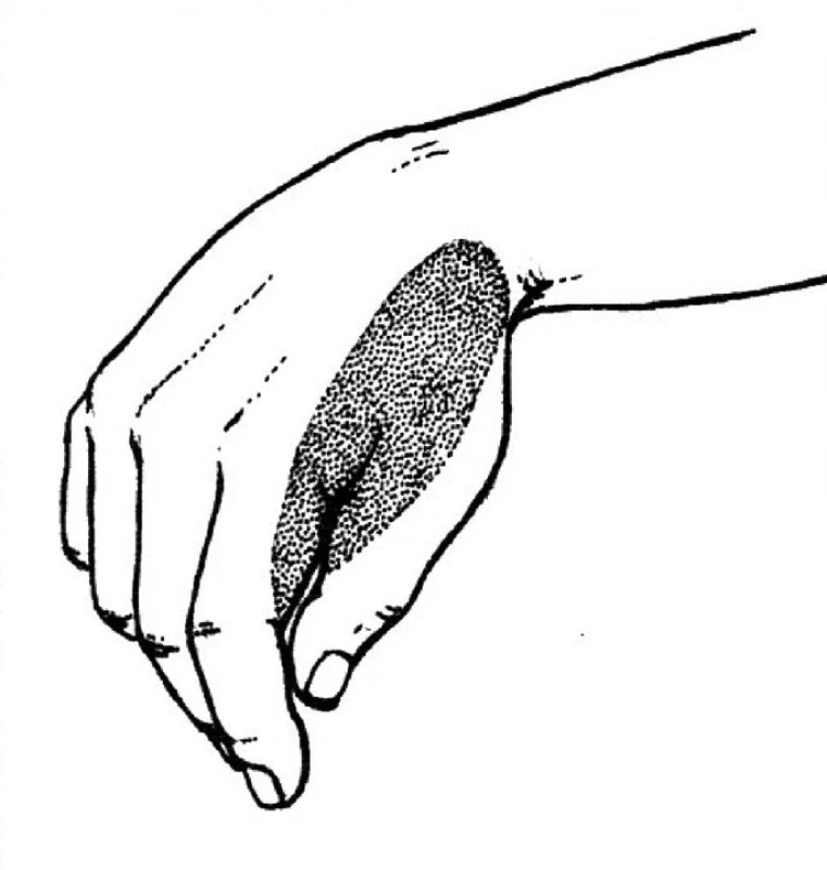 Léze n. radialis na paži.
Paréza radiální i dorzální skupiny svalů předloktí – „dropping hand and dropping fingers“, ruka i prsty
přepadají. Poruchy čití jsou v autonomní kožní zóně.