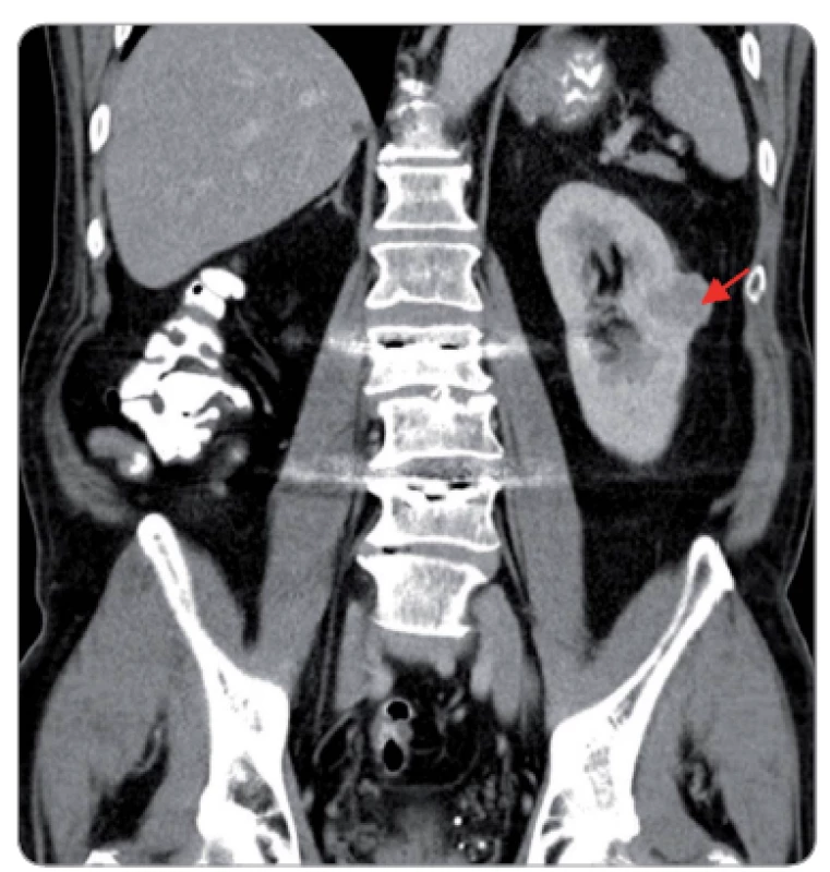 CT obraz u 62-ročného muža po pravostrannej nefrektómii pre zhubný nádor obličky pred 11 rokmi s nálezom RCC v strednej tretine ľavej obličky (červená šípka); urobená resekcia tumoru; pacient žije 6 rokov po druhej operácii [18,19].