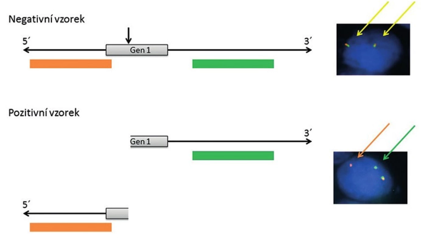 Schematické zobrazení „break-apart“ sondy, principu detekce zlomu určitého genu (Gen 1) a jejich projev v jádře buňky po FISH analýze.