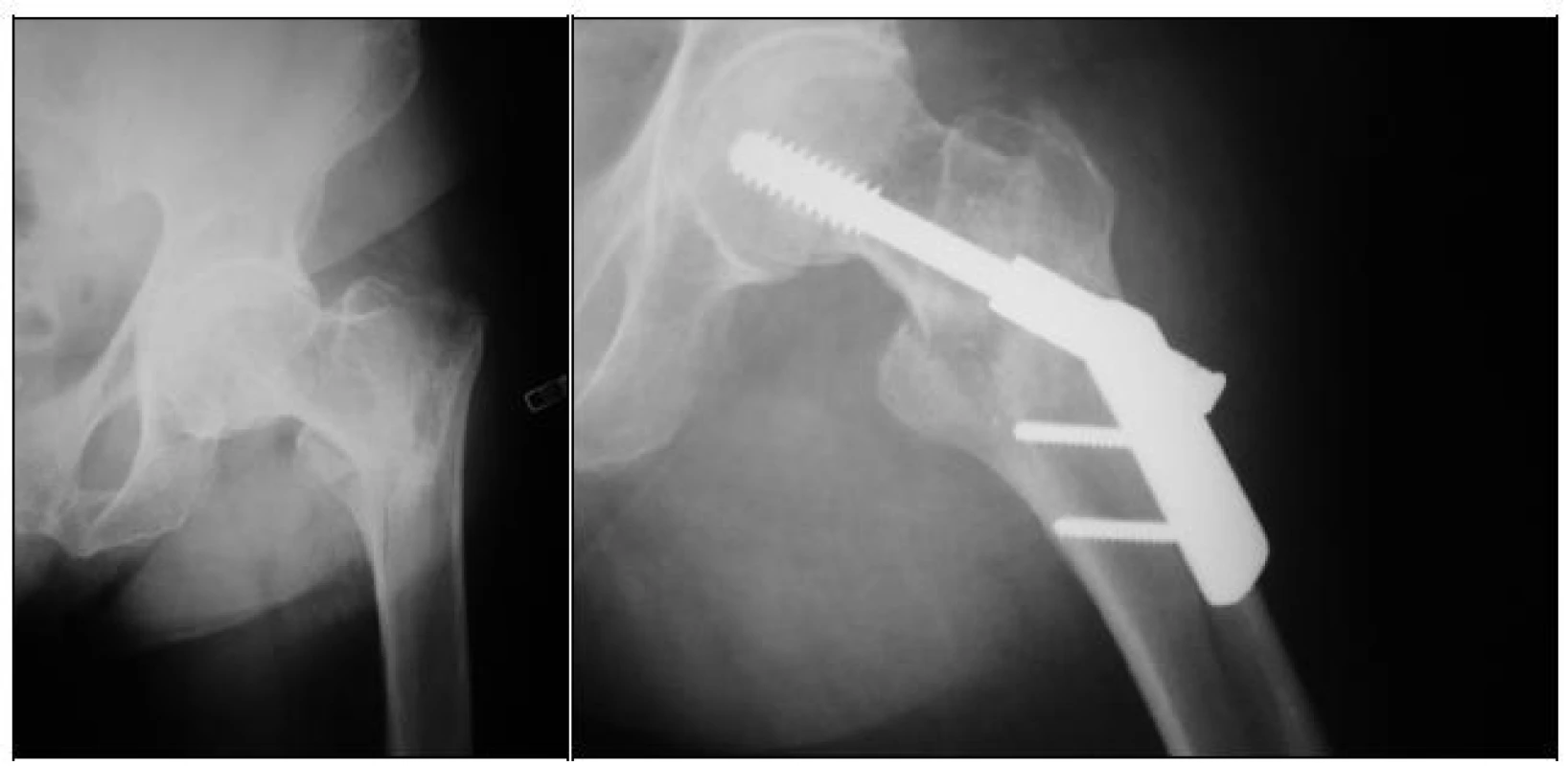 RTG dokumentace 76leté pacientky s primárně „podceněnou“ zlomeninou proximálního femuru, která zasahovala až pod úroveň malého trochanteru 
a - úrazový snímek
b - stav po osteosyntéze 2otvorovou DHS dlahou, patrná linie lomu distálně pod dlahou