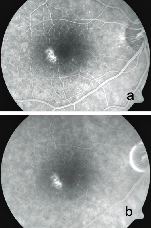 Fluorescenční angiografie s mírnou poruchou pigmentace okolo centra a ložiskovým „window“ defektem v makule pravého oka a) ve 42. vteřině, b) v 7. minutě