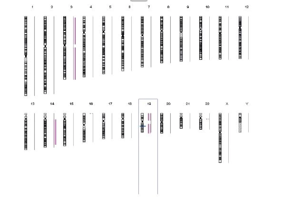 Trizomie chromozomů 3 a 14 a monozomie chromozomu 19 detekovaná pomocí techniky array-CGH s využitím oligonukleotidových DNA mikročipů Single Cell Aneuploidy Array 8 × 15 K (Oxford Gene Technology) u buněk z blastocysty