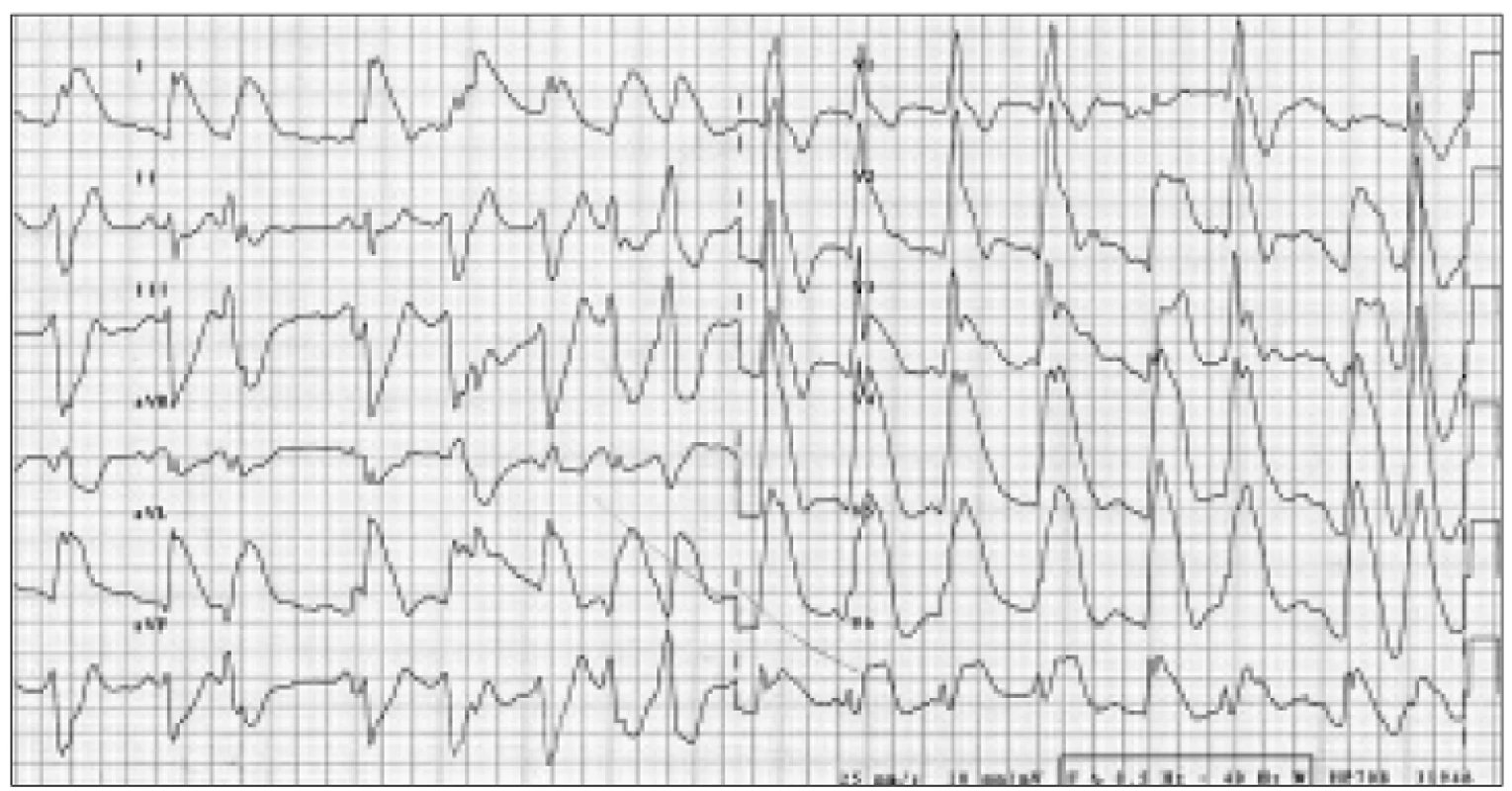 Elevace ST úseků I, aVL, V&lt;sub&gt;2–6&lt;/sub&gt; na vstupním EKG.