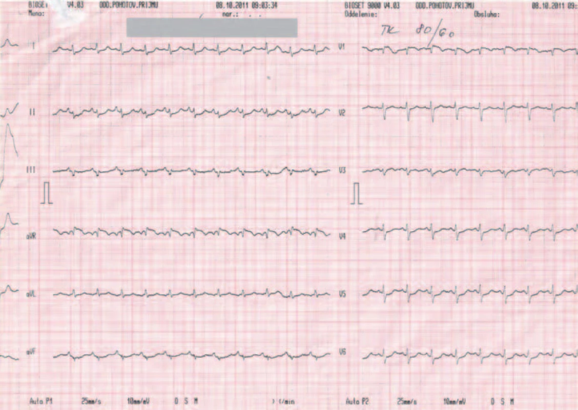 EKG záznam pri urgentnom vyšetrení v porovnaní so záznamom z dokumentácie – sínusová tachykardia, kmit S v I, Q v III, inkompletný blok pravého Tawarovho ramienka.