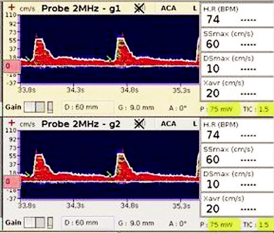 TCD záznam na a. cerebri media Zobrazuje snížené maximální rychlosti průtoku krve v systole a diastole (SSmax a DSmax) a sníženou maximální průměrnou rychlost (Xavr).