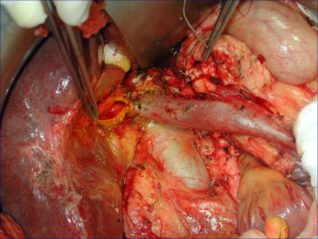 Stav po proximální pankreatoduodenektomii se standardní lymfadenektomií (peroperační foto)