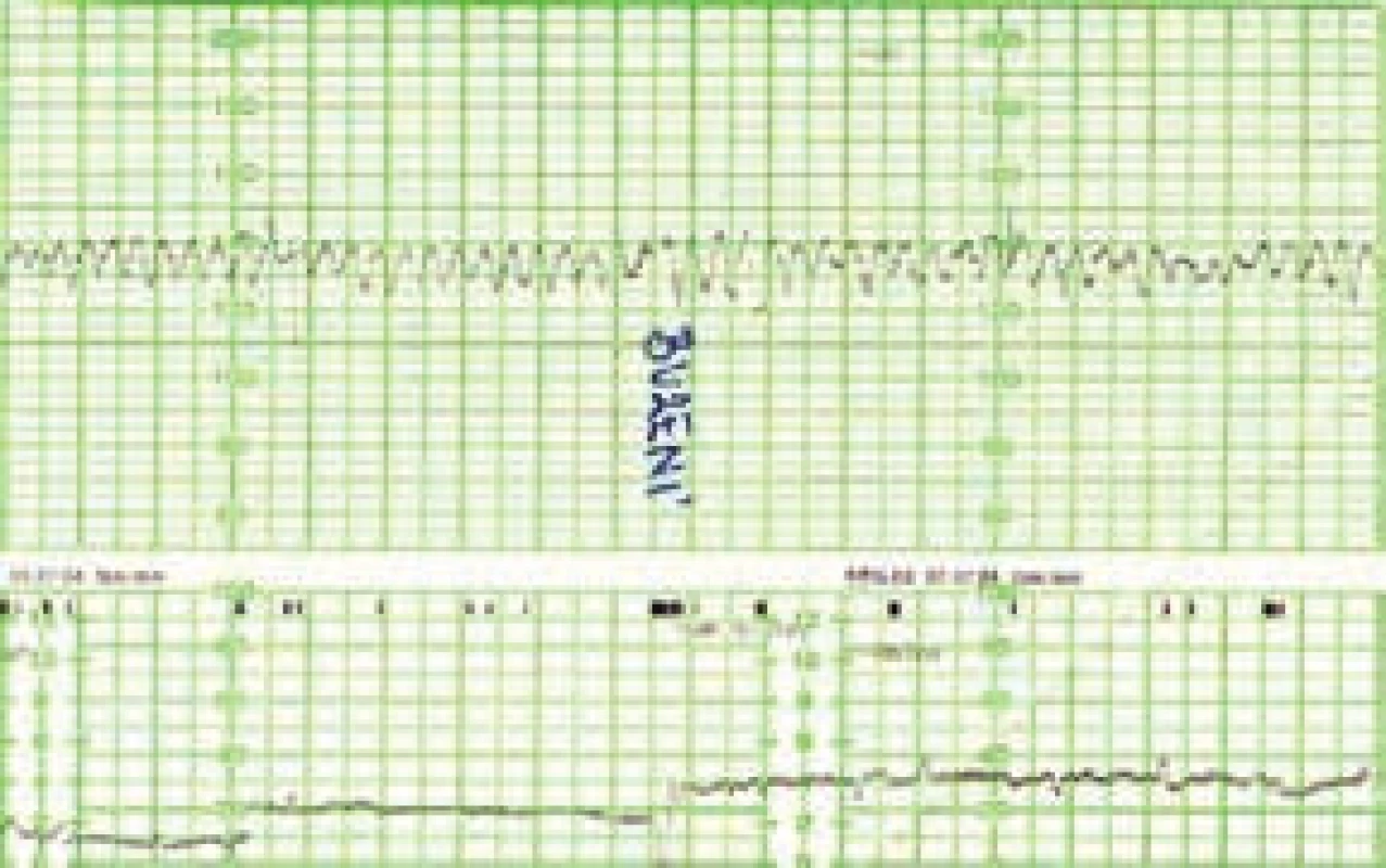 Typický kardiotokografický (CTG) záznam těžce anemického plodu ve 3. trimestru